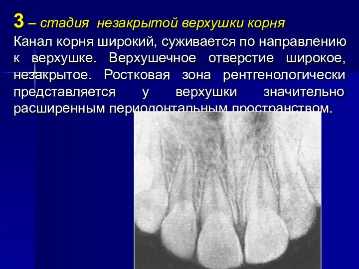 3 – стадия незакрытой верхушки корня Канал корня широкий, суживается по