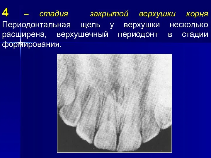 4 – стадия закрытой верхушки корня Периодонтальная щель у верхушки несколько