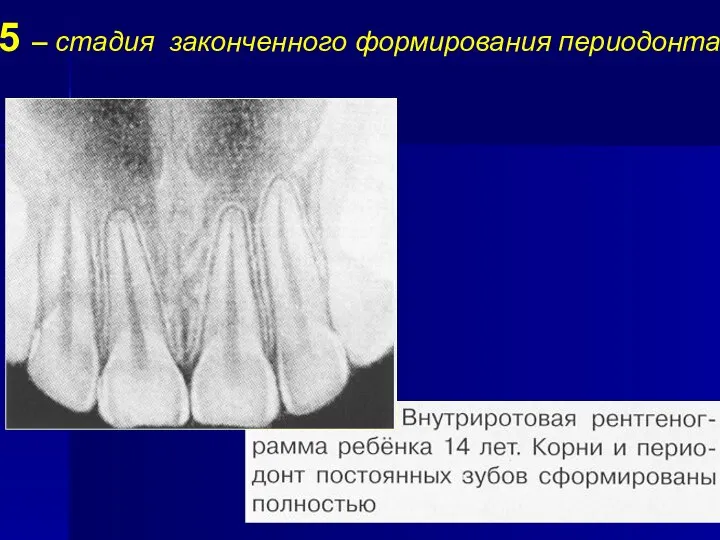 5 – стадия законченного формирования периодонта