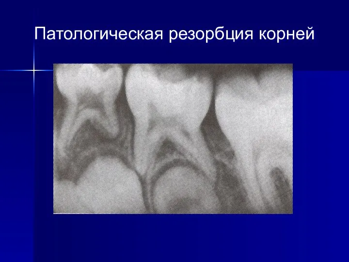 Патологическая резорбция корней