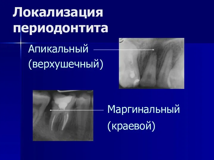 Локализация периодонтита Апикальный (верхушечный) Маргинальный (краевой)