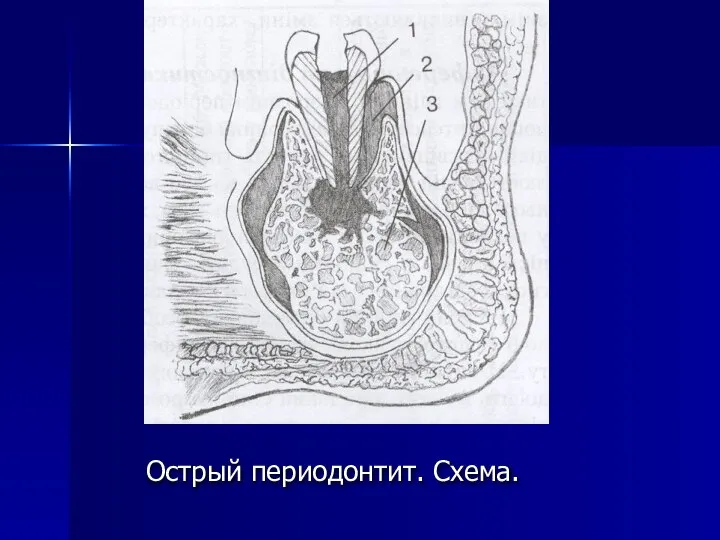 Острый периодонтит. Схема.