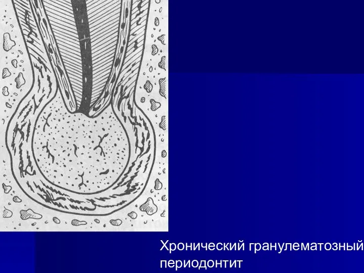 Хронический гранулематозный периодонтит