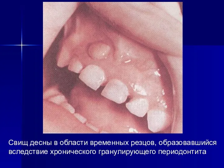 Свищ десны в области временных резцов, образовавшийся вследствие хронического гранулирующего периодонтита