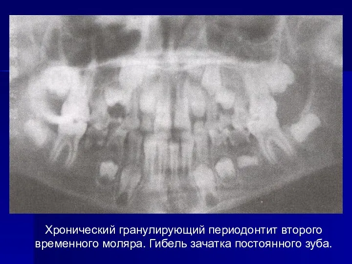 Хронический гранулирующий периодонтит второго временного моляра. Гибель зачатка постоянного зуба.