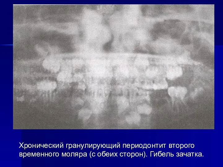 Хронический гранулирующий периодонтит второго временного моляра (с обеих сторон). Гибель зачатка.