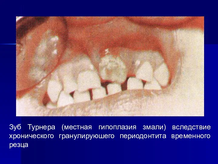 Зуб Турнера (местная гипоплазия змали) вследствие хронического гранулируюшего периодонтита временного резца
