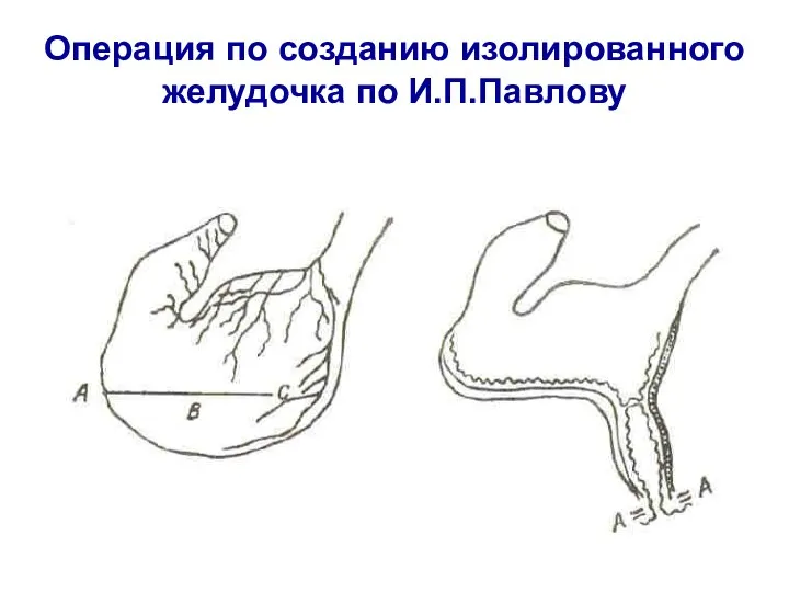 Операция по созданию изолированного желудочка по И.П.Павлову