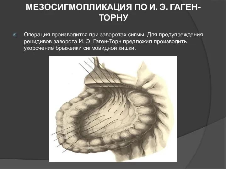 МЕЗОСИГМОПЛИКАЦИЯ ПО И. Э. ГАГЕН-ТОРНУ Операция производится при заворотах сигмы. Для