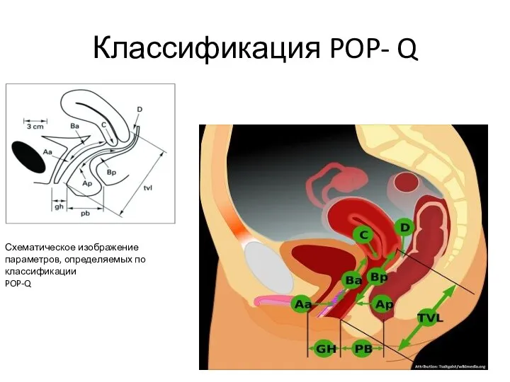 Классификация POP- Q Схематическое изображение параметров, определяемых по классификации POP-Q