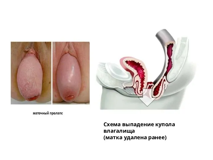 Схема выпадение купола влагалища (матка удалена ранее)