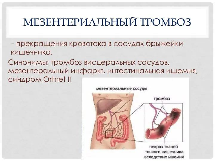 МЕЗЕНТЕРИАЛЬНЫЙ ТРОМБОЗ – прекращения кровотока в сосудах брыжейки кишечника. Синонимы: тромбоз