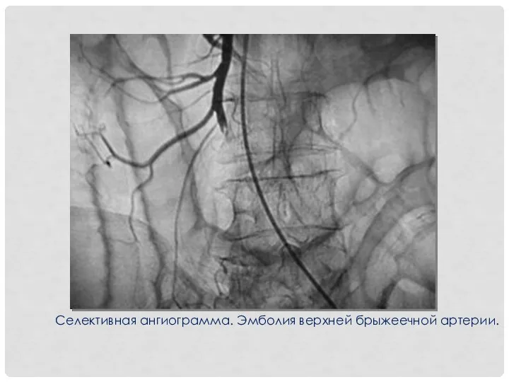 Селективная ангиограмма. Эмболия верхней брыжеечной артерии.