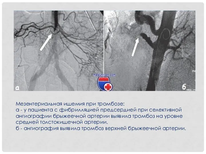 Мезентериальная ишемия при тромбозе: а - у пациента с фибрилляцией предсердией