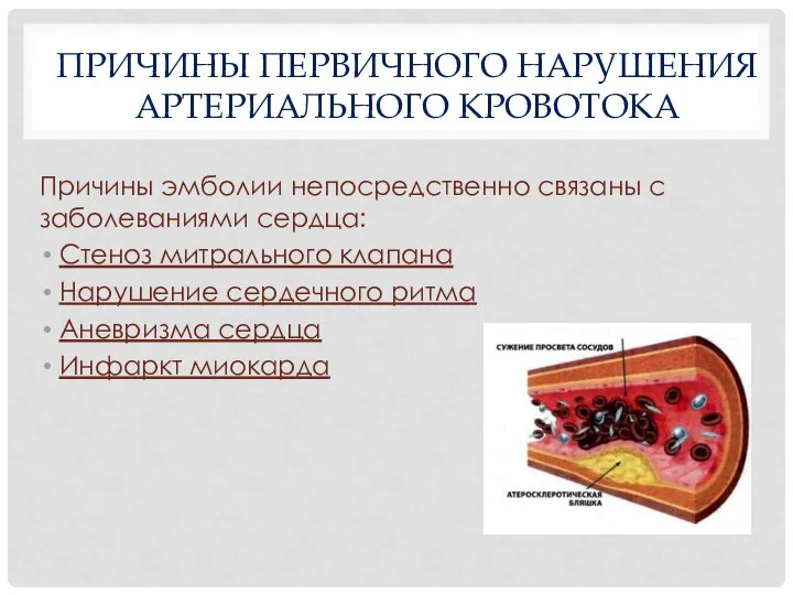 ПРИЧИНЫ ПЕРВИЧНОГО НАРУШЕНИЯ АРТЕРИАЛЬНОГО КРОВОТОКА Причины эмболии непосредственно связаны с заболеваниями