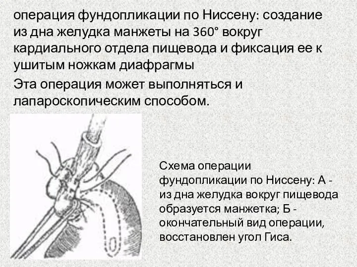 операция фундопликации по Ниссену: создание из дна желудка манжеты на 360°