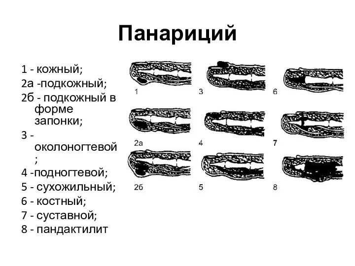 Панариций 1 - кожный; 2а -подкожный; 2б - подкожный в форме