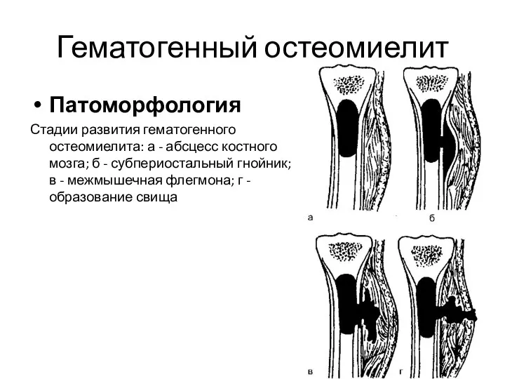 Гематогенный остеомиелит Патоморфология Стадии развития гематогенного остеомиелита: а - абсцесс костного