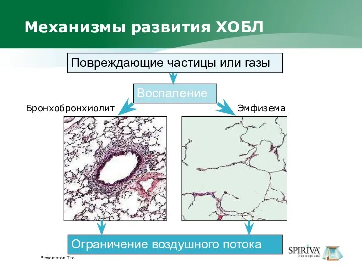 Presentation Title Механизмы развития ХОБЛ Воспаление Повреждающие частицы или газы Ограничение воздушного потока Эмфизема Бронхобронхиолит