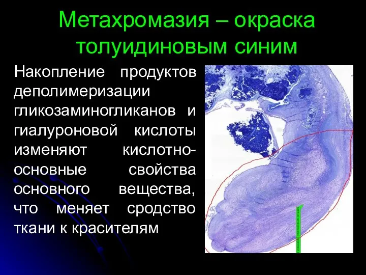 Метахромазия – окраска толуидиновым синим Накопление продуктов деполимеризации гликозаминогликанов и гиалуроновой