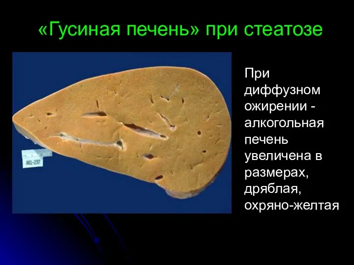 «Гусиная печень» при стеатозе При диффузном ожирении - алкогольная печень увеличена в размерах, дряблая, охряно-желтая