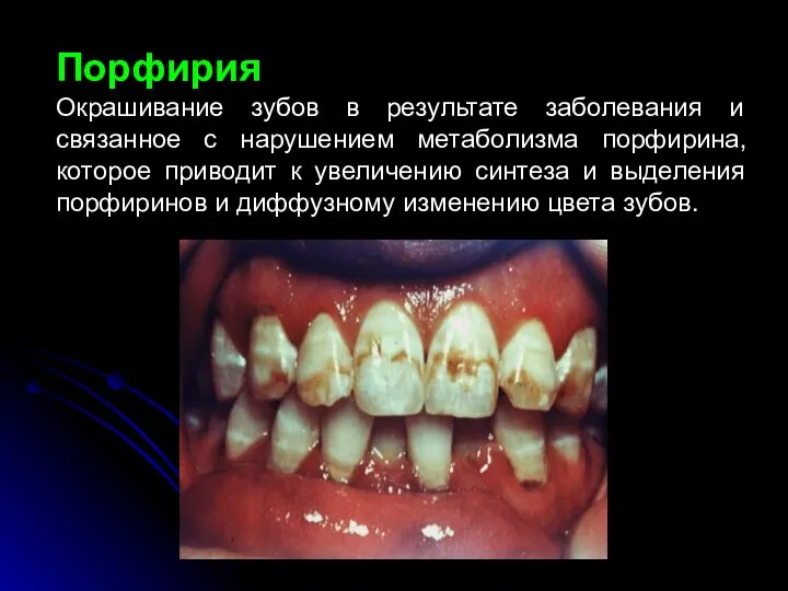 Порфирия Окрашивание зубов в результате заболевания и связанное с нарушением метаболизма