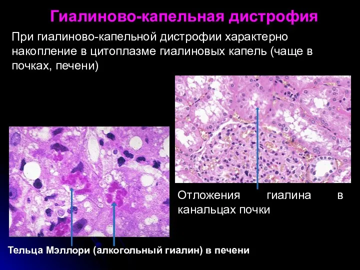 Тельца Мэллори (алкогольный гиалин) в печени При гиалиново-капельной дистрофии характерно накопление