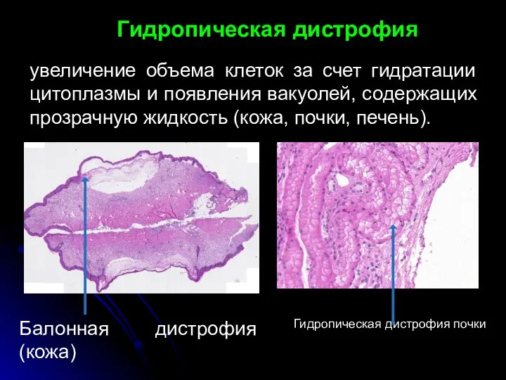 Гидропическая дистрофия Балонная дистрофия (кожа) увеличение объема клеток за счет гидратации