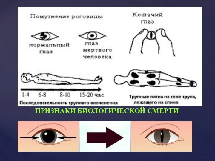 ПРИЗНАКИ БИОЛОГИЧЕСКОЙ СМЕРТИ