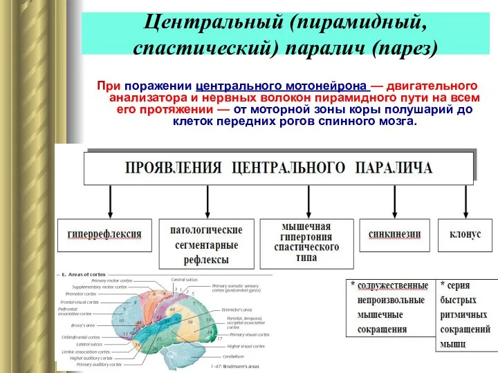 Центральный (пирамидный, спастический) паралич (парез) При поражении центрального мотонейрона — двигательного