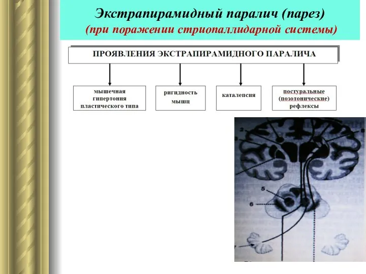 Экстрапирамидный паралич (парез) (при поражении стриопаллидарной системы)