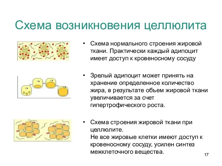 Схема возникновения целлюлита Схема нормального строения жировой ткани. Практически каждый адипоцит