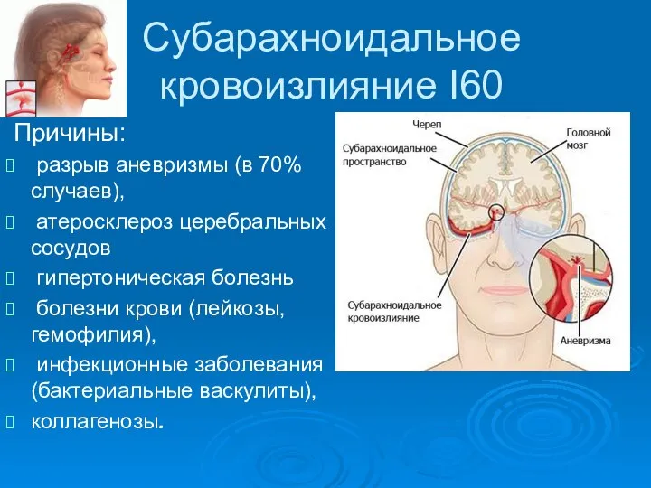 Субарахноидальное кровоизлияние I60 Причины: разрыв аневризмы (в 70% случаев), атеросклероз церебральных