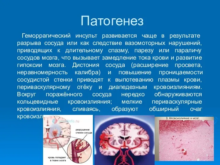 Патогенез Геморрагический инсульт развивается чаще в результате разрыва сосуда или как