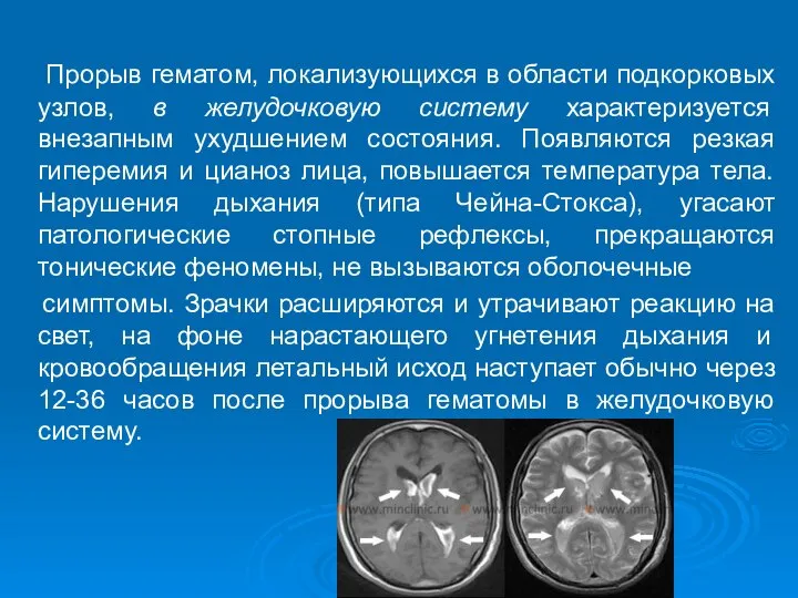 Прорыв гематом, локализующихся в области подкорковых узлов, в желудочковую систему характеризуется