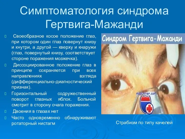 Симптоматология синдрома Гертвига-Мажанди Своеобразное косое положение глаз, при котором один глаз