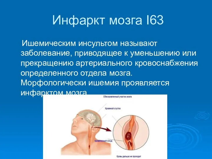 Инфаркт мозга I63 Ишемическим инсультом называют заболевание, приводящее к уменьшению или