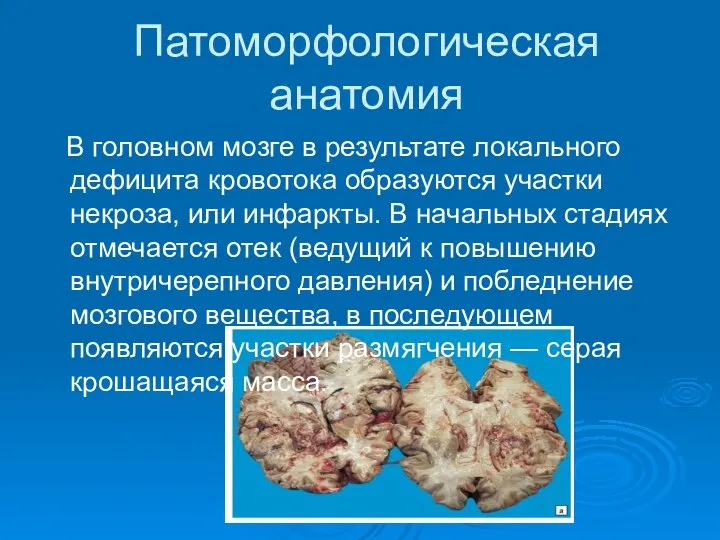 Патоморфологическая анатомия В головном мозге в результате локального дефицита кровотока образуются