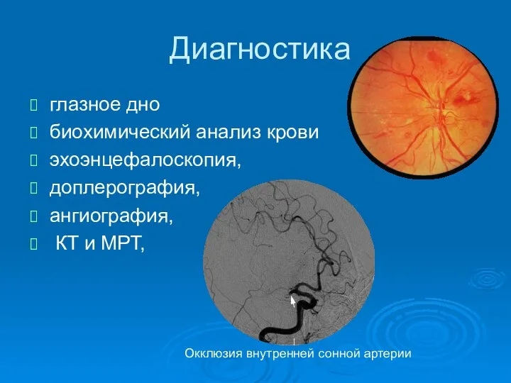 Диагностика глазное дно биохимический анализ крови эхоэнцефалоскопия, доплерография, ангиография, КТ и МРТ, Окклюзия внутренней сонной артерии