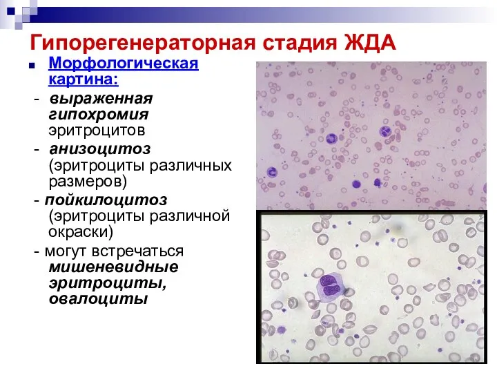 Гипорегенераторная стадия ЖДА Морфологическая картина: - выраженная гипохромия эритроцитов - анизоцитоз