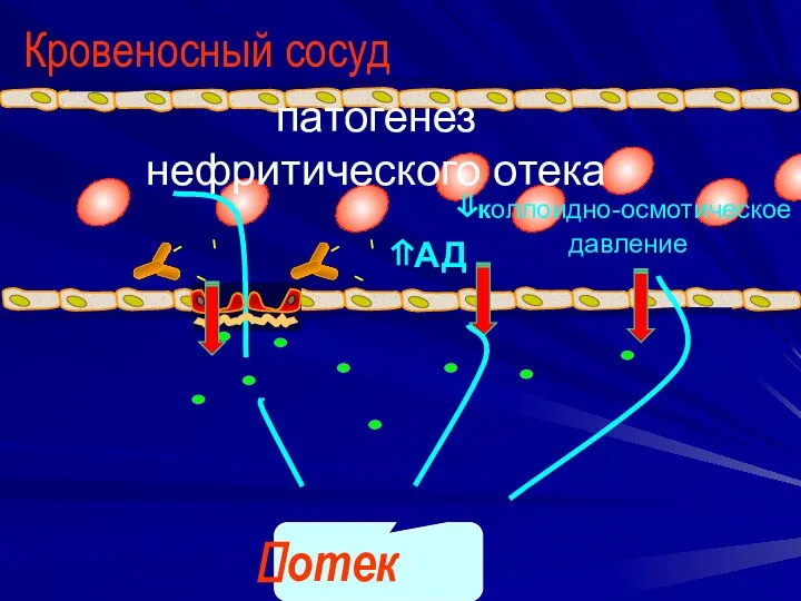 ⇑АД отек ⇓коллоидно-осмотическое давление патогенез нефритического отека Кровеносный сосуд