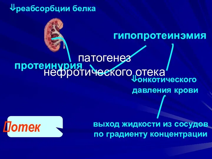 протеинурия гипопротеинэмия ⇓онкотического давления крови отек выход жидкости из сосудов по