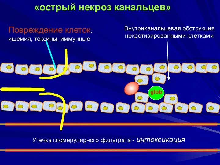 Повреждение клеток: ишемия, токсины, иммунные Внутриканальцевая обструкция некротизированными клетками Утечка гломерулярного