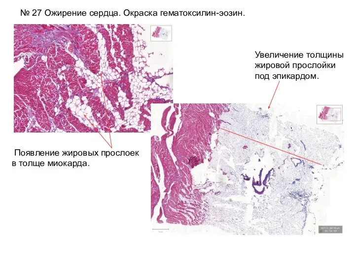 № 27 Ожирение сердца. Окраска гематоксилин-эозин. Появление жировых прослоек в толще