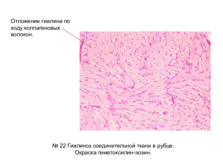 № 22 Гиалиноз соединительной ткани в рубце. Окраска гематоксилин-эозин. Отложение гиалина по ходу коллагеновых волокон.