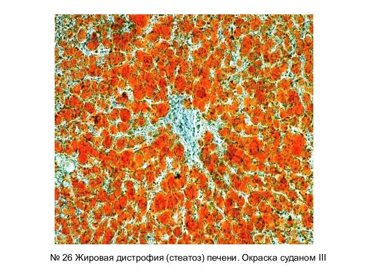 № 26 Жировая дистрофия (стеатоз) печени. Окраска cуданом III