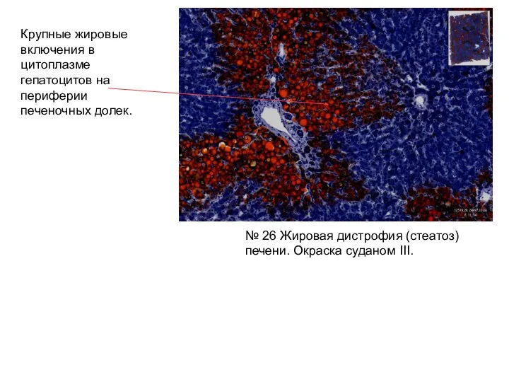 Крупные жировые включения в цитоплазме гепатоцитов на периферии печеночных долек. №