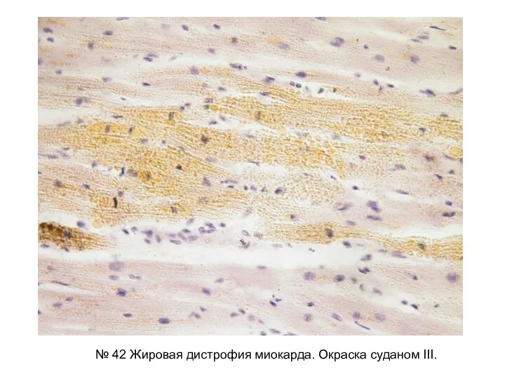 № 42 Жировая дистрофия миокарда. Окраска cуданом III.