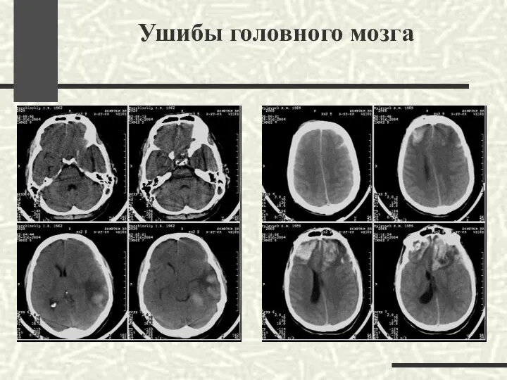 Ушибы головного мозга