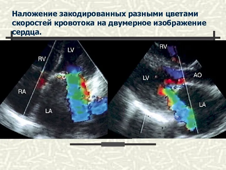 Наложение закодированных разными цветами скоростей кровотока на двумерное изображение сердца.